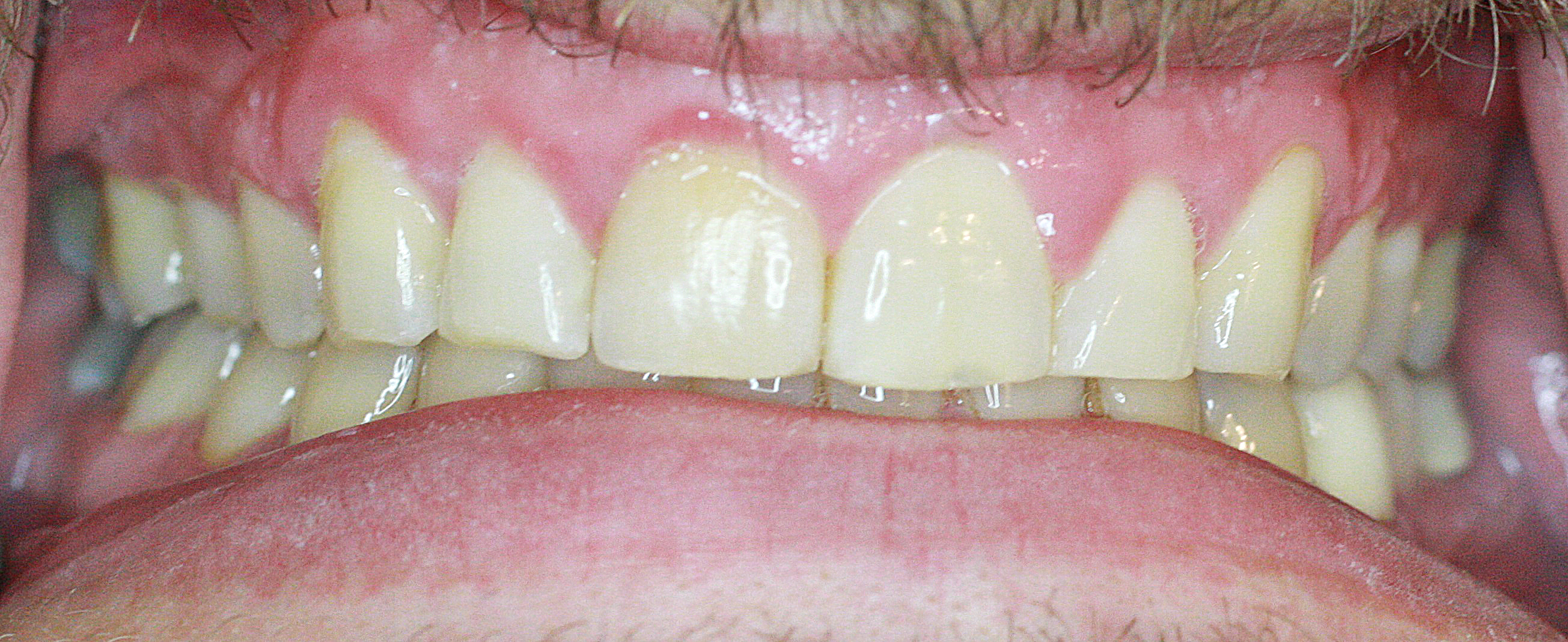 Invisalign Case 1 after
