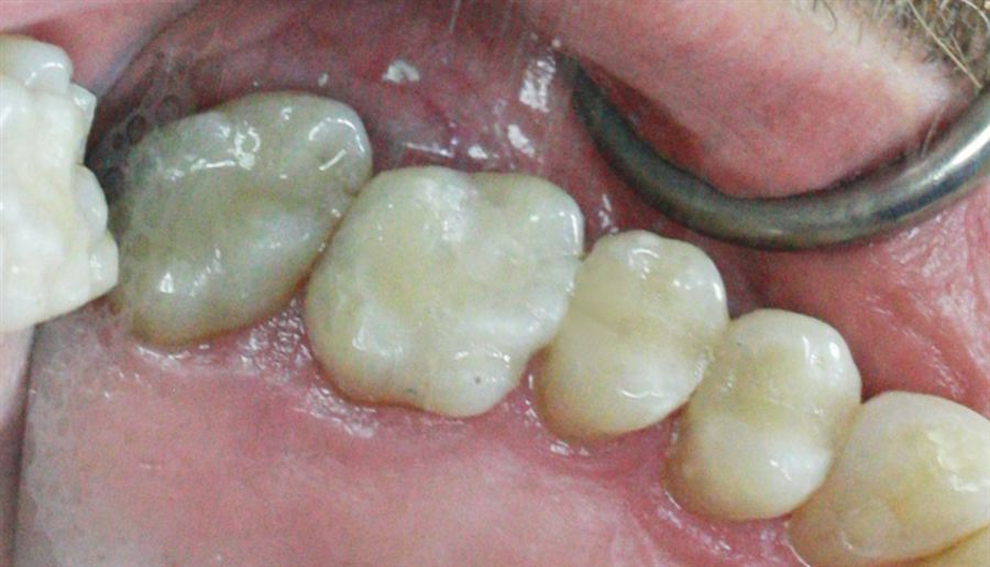 Amalgam to composite filling after