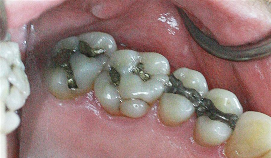 Amalgam to composite filling before