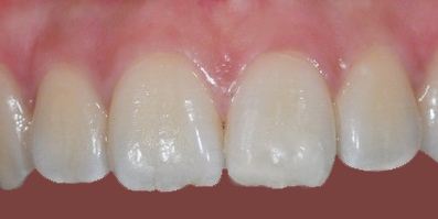 Composite filling after