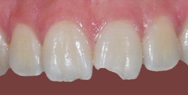 Composite filling before
