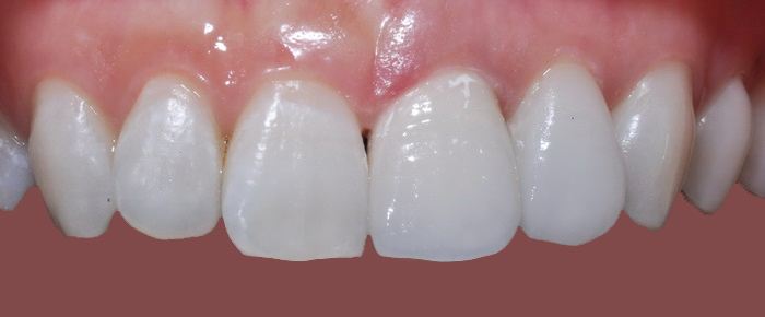 Dental crown after — Noa Dental Valencia
