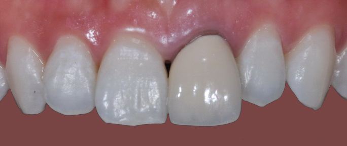 Dental crown before — Noa Dental Valencia