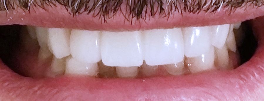 Front teeth bridge after — Noa Dental Valencia