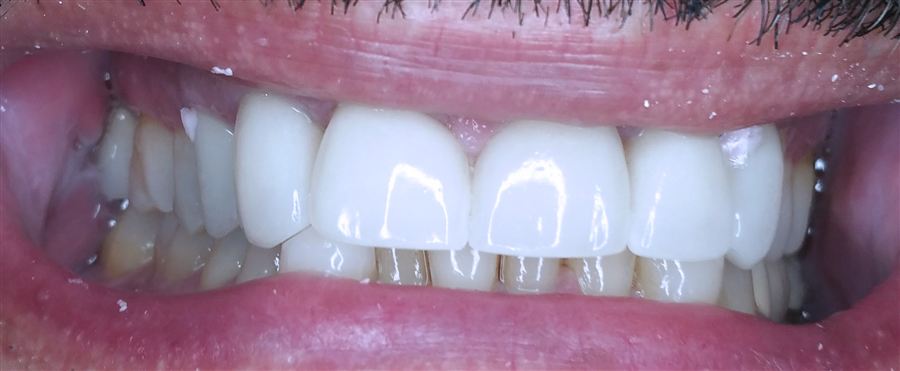 Front teeth bridge before — Noa Dental Valencia