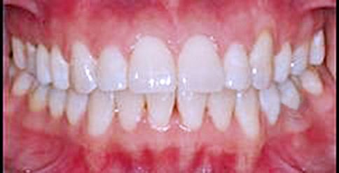 Invisalign after — Noa Dental Valencia