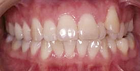 Invisalign before — Noa Dental Valencia