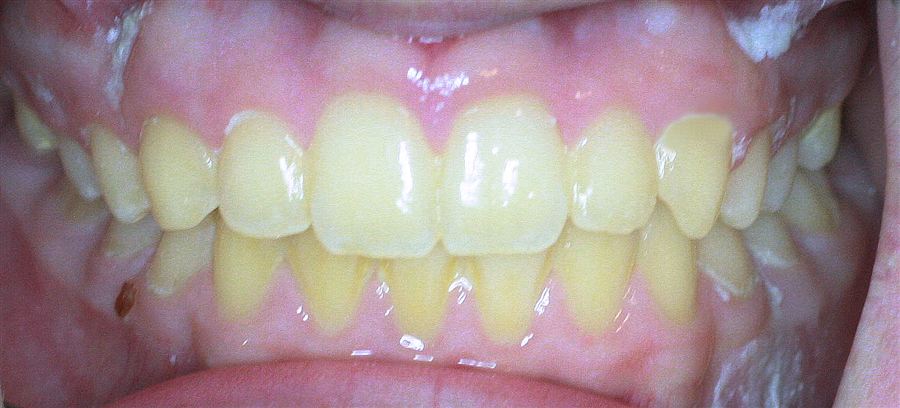 Invisalign after — case 2