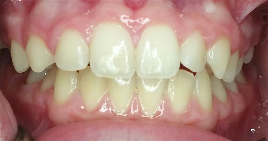 Invisalign before — case 2