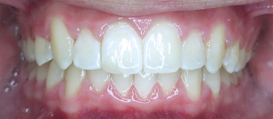 Six month braces after — Noa Dental Valencia