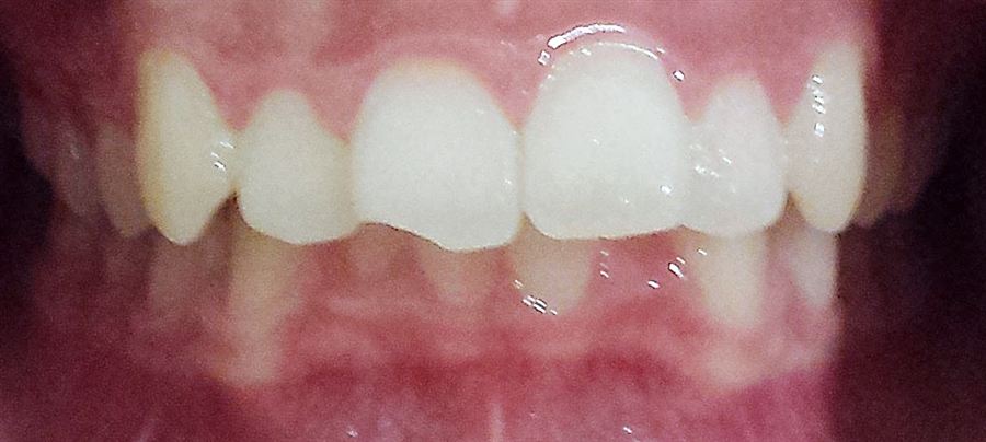 Six month braces before — Noa Dental Valencia