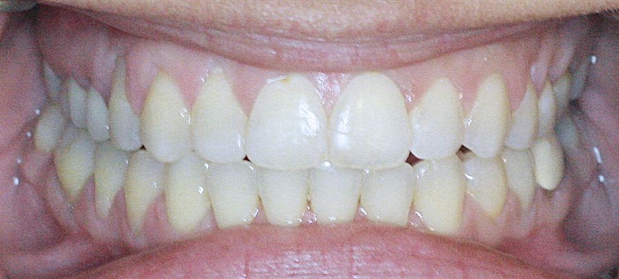 Six month braces after — case 2