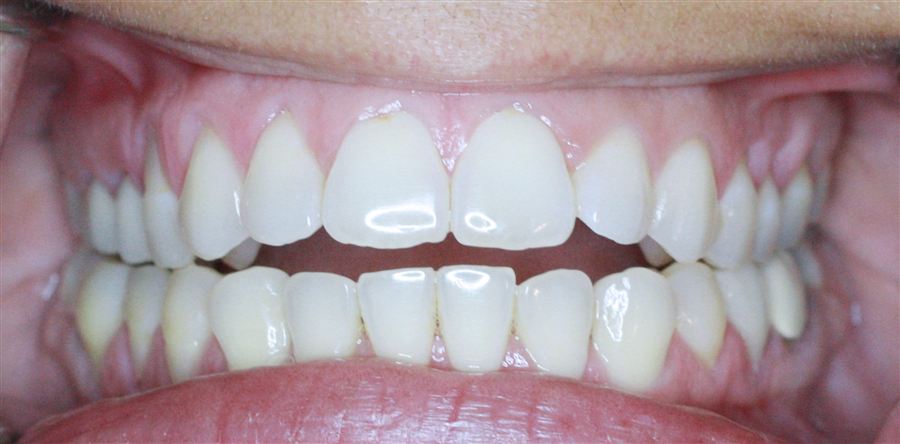 Six month braces before — case 2