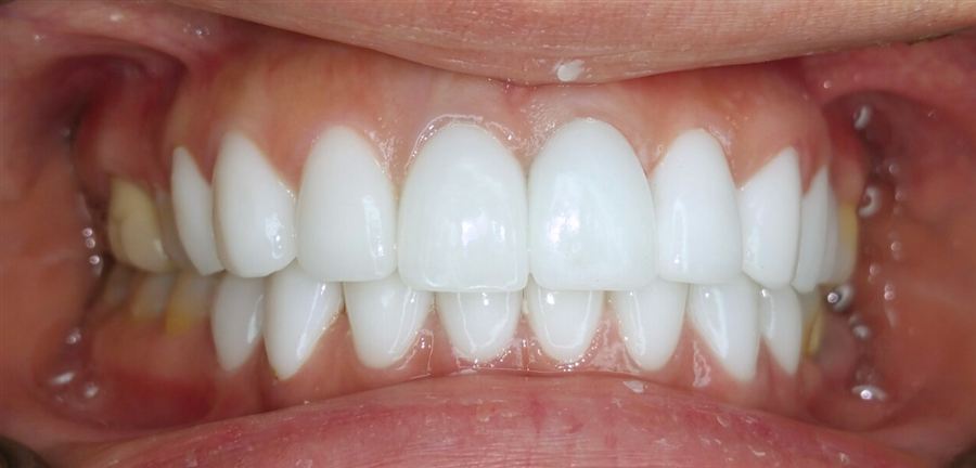 Porcelain veneers after — Noa Dental Valencia
