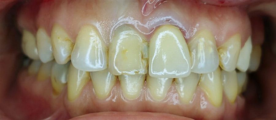 Porcelain veneers before — Noa Dental Valencia