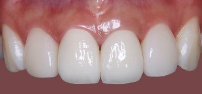 Porcelain veneers after — case 2