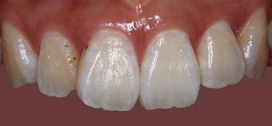 Porcelain veneers before — case 2