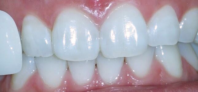 Teeth whitening after — Noa Dental Valencia