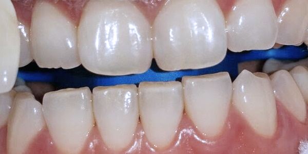 Teeth whitening before — Noa Dental Valencia