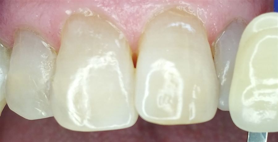 Teeth whitening after — case 2
