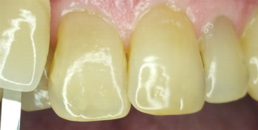 Teeth whitening before — case 2